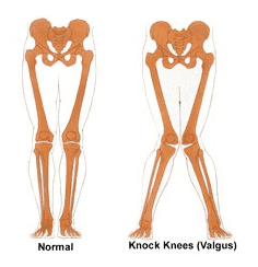 Knees internally rotating while squatting can cause shin splints