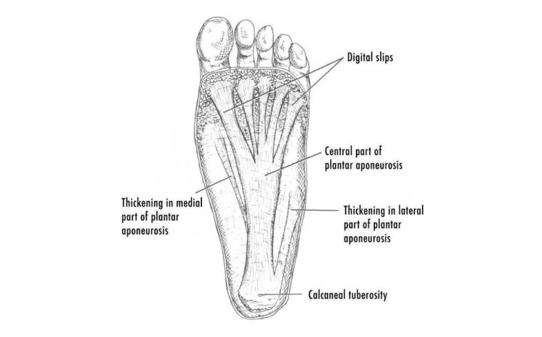 plantar fasciitis is an inflammatory condition that causes this tissue to generate a lot of pain in your heel area