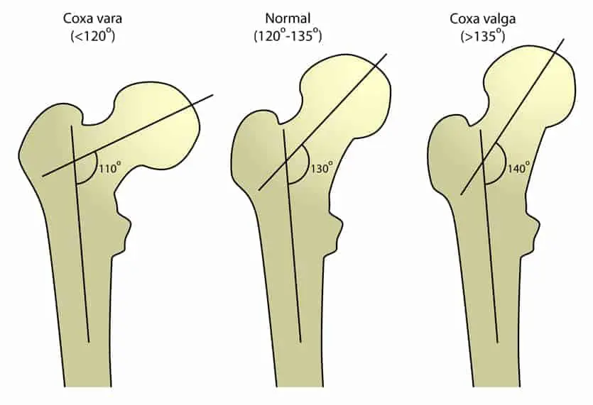 having a shallow hip socket means that the way the pelvis, hip socket, and femur connect has a lower angle than what’s considered normal