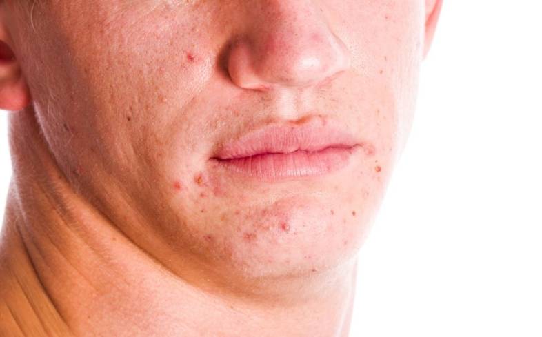 when you sweat, it creates a perfect environment for the acne-causing bacteria