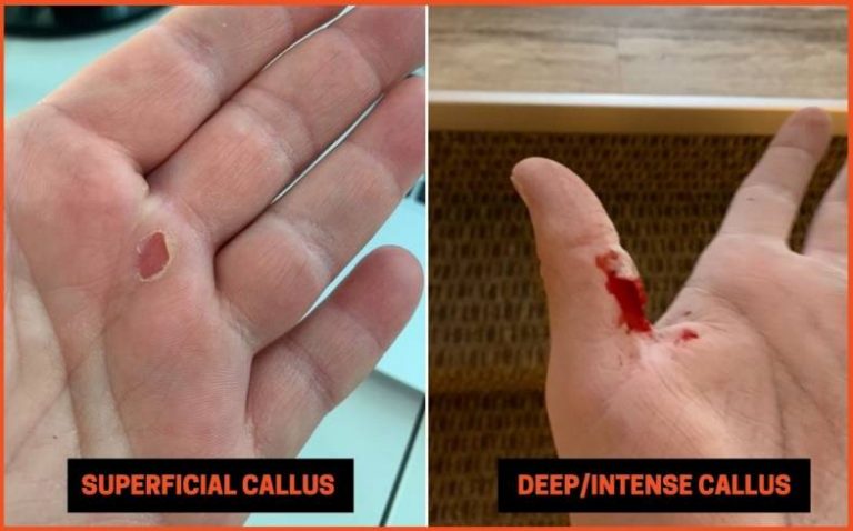 How To Get Rid Of Calluses On Hands From Lifting