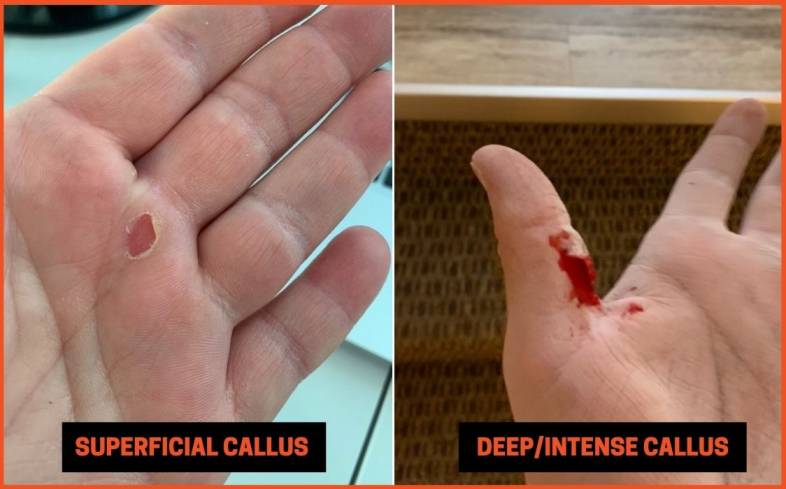two types of calluses you get from lifting weights