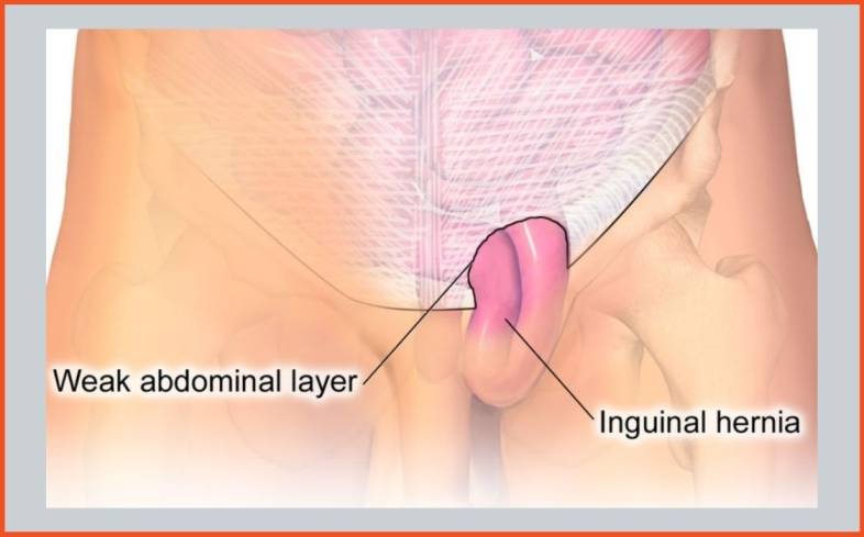 learn the basics of what hernias are and why they occur