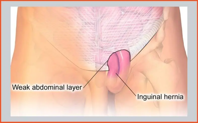 learn the basics of what hernias are and why they occur