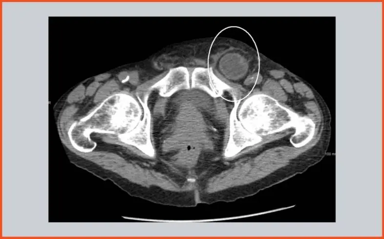 a hernia or herniation refers to an abnormal opening within a tissue wall through which an organ either bulges or pokes through