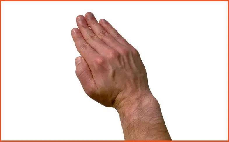 Radial deviation of the wrist
