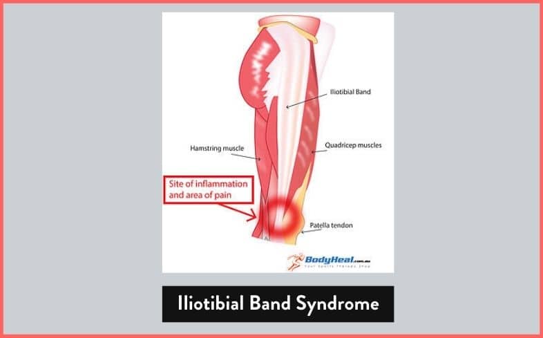 IT band syndrome